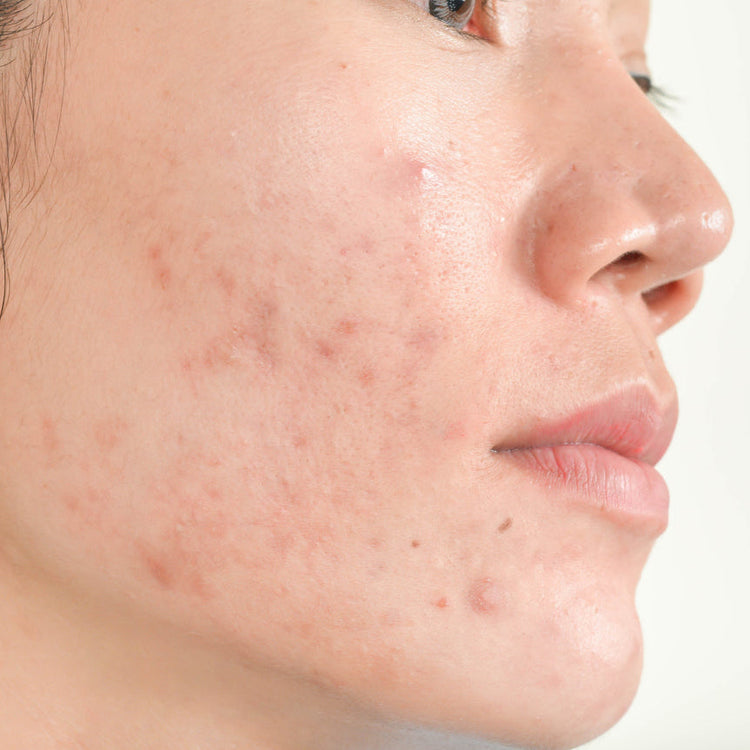 Acne Treatments