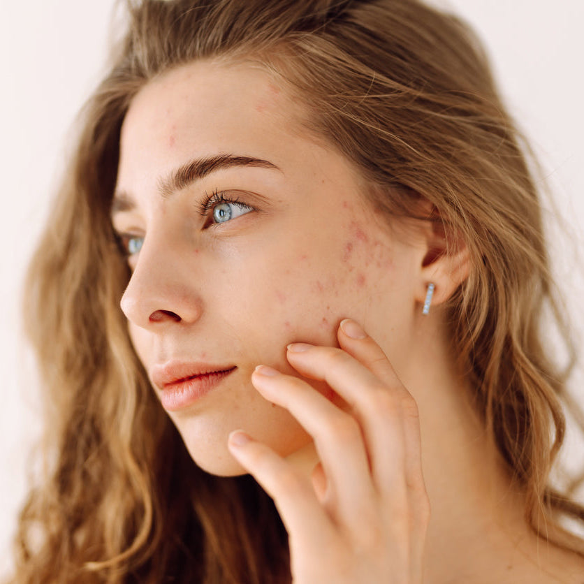 Acne + Blemishes