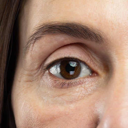 Dark Circles + Puffiness